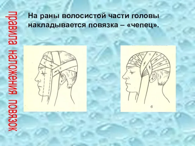 На раны волосистой части головы накладывается повязка – «чепец». правила наложения повязок