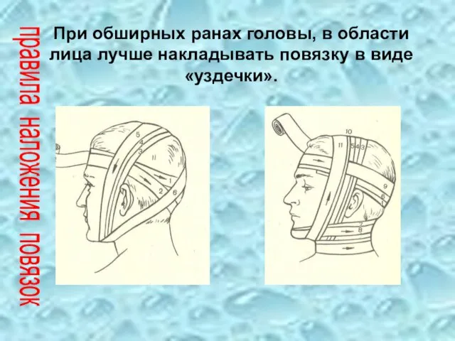При обширных ранах головы, в области лица лучше накладывать повязку в виде «уздечки». правила наложения повязок