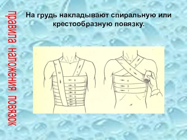 На грудь накладывают спиральную или крестообразную повязку. правила наложения повязок