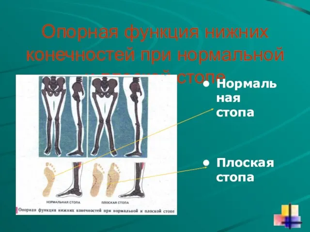 Опорная функция нижних конечностей при нормальной и плоской стопе Нормальная стопа Плоская стопа