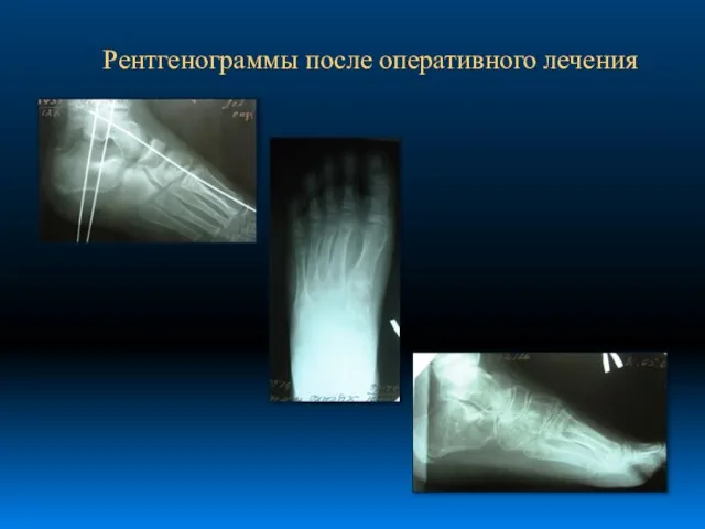 Рентгенограммы после оперативного лечения