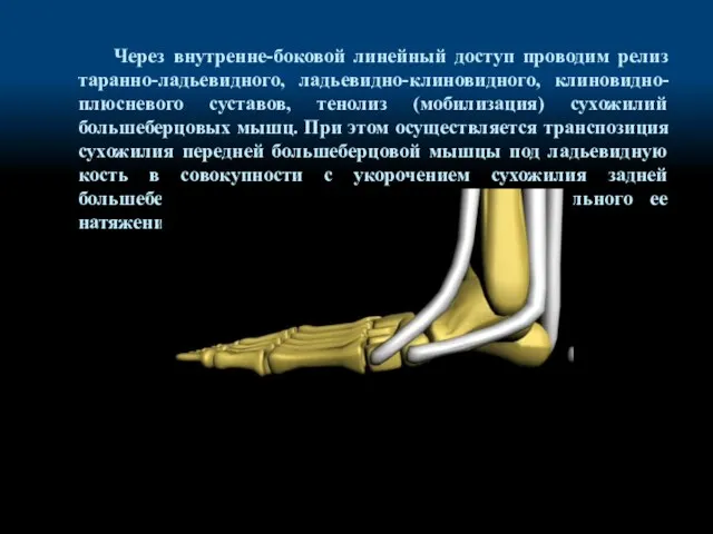 Через внутренне-боковой линейный доступ проводим релиз таранно-ладьевидного, ладьевидно-клиновидного, клиновидно-плюсневого суставов, тенолиз (мобилизация)