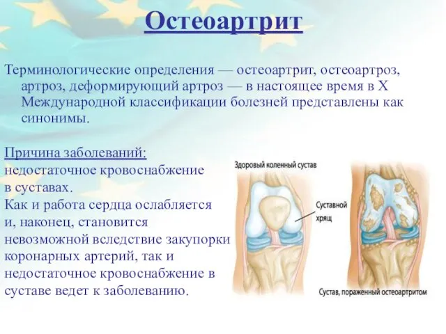 Остеоартрит Терминологические определения — остеоартрит, остеоартроз, артроз, деформирующий артроз — в настоящее