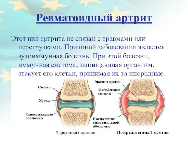 Ревматоидный артрит Этот вид артрита не связан с травмами или перегрузками. Причиной