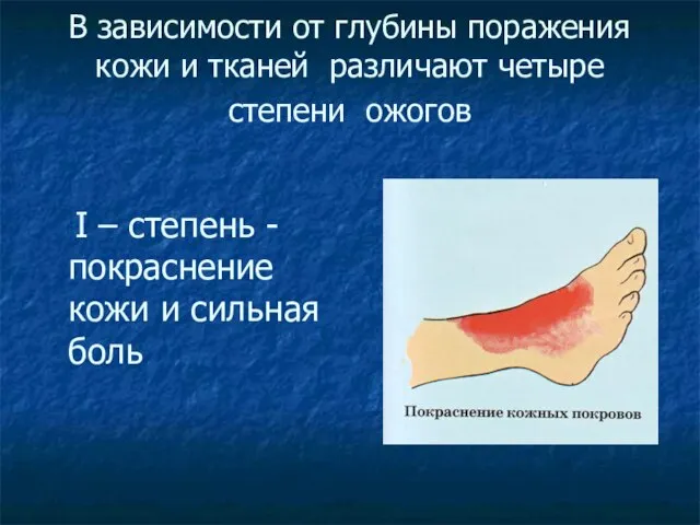 В зависимости от глубины поражения кожи и тканей различают четыре степени ожогов