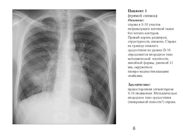 Пациент 1 (прямой снимок) Описание: справа в S-10 участок инфильтрации легочной ткани