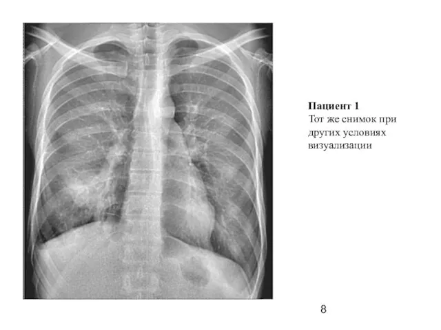 Пациент 1 Тот же снимок при других условиях визуализации