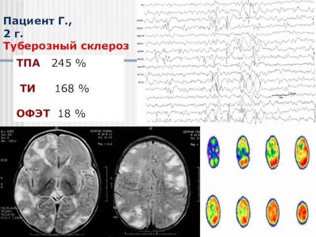 Пациент Г., 2 г. Туберозный склероз ТПА 245 % ТИ 168 % ОФЭТ 18 %