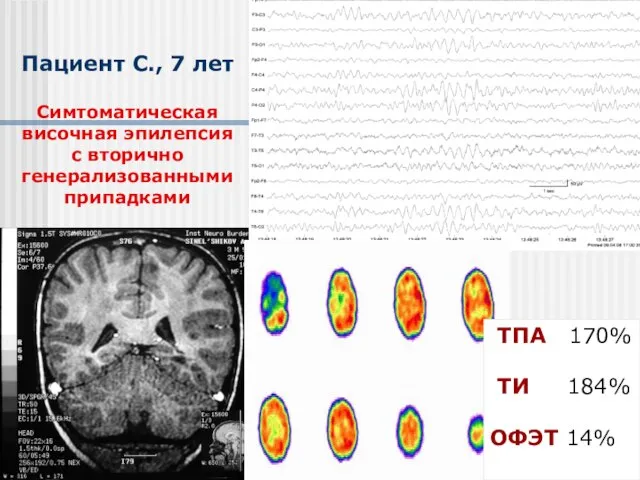 Пациент С., 7 лет Симтоматическая височная эпилепсия с вторично генерализованными припадками ТПА