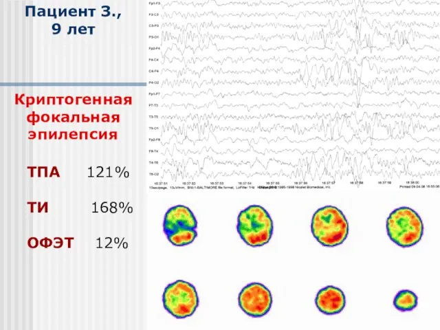 Пациент З., 9 лет Криптогенная фокальная эпилепсия ТПА 121% ТИ 168% ОФЭТ 12%