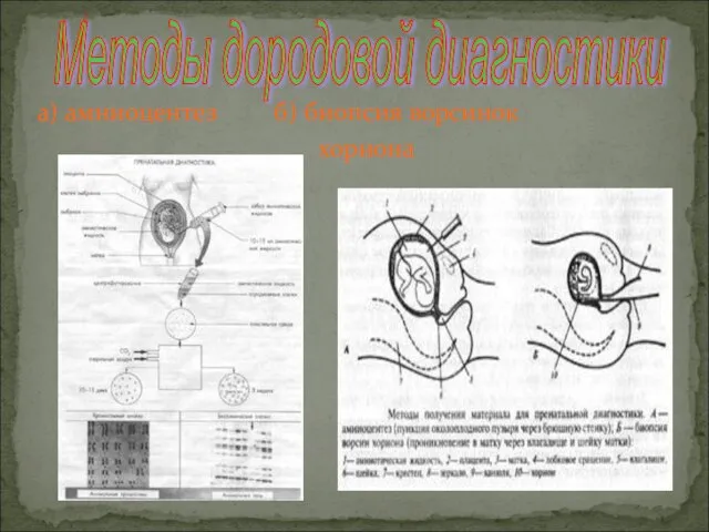 а) амниоцентез б) биопсия ворсинок хориона Методы дородовой диагностики