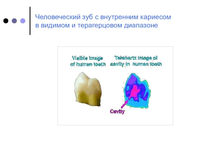 Человеческий зуб с внутренним кариесом в видимом и терагерцовом диапазоне