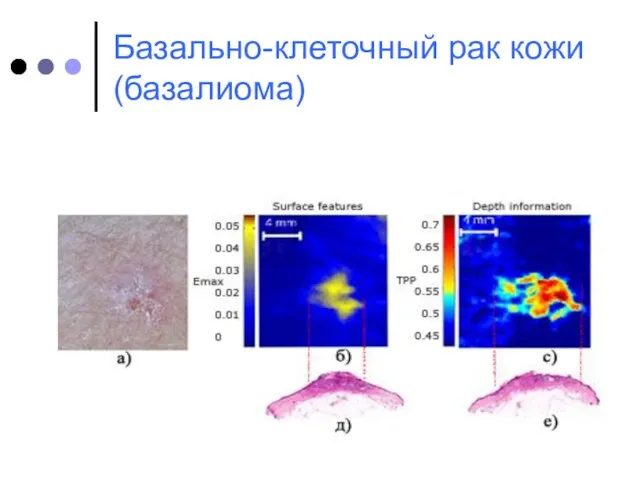 Базально-клеточный рак кожи (базалиома)