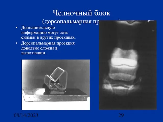 08/14/2023 Челночный блок (дорсопальмарная проекция) Дополнительную информацию могут дать снимки в других