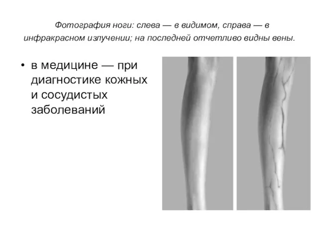 Фотография ноги: слева — в видимом, справа — в инфракрасном излучении; на