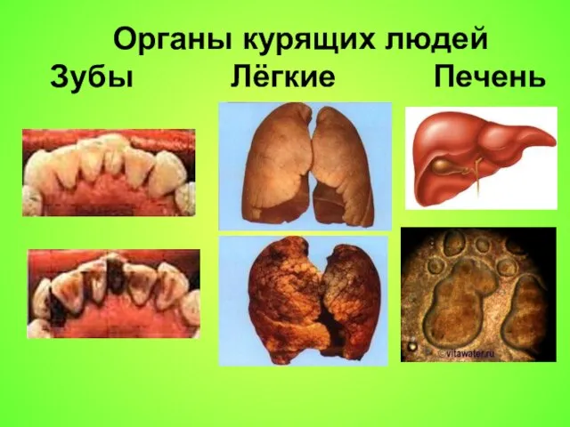 Органы курящих людей Зубы Лёгкие Печень