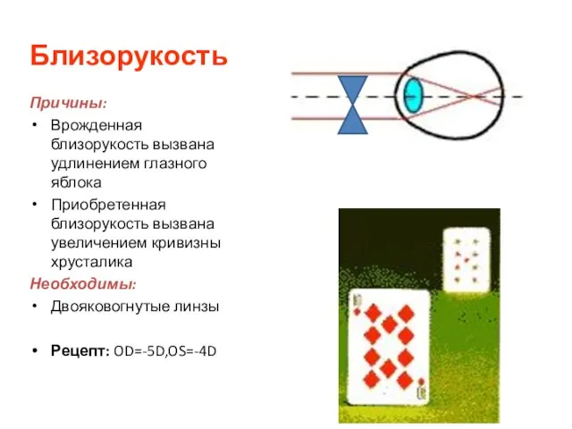 Близорукость Причины: Врожденная близорукость вызвана удлинением глазного яблока Приобретенная близорукость вызвана увеличением