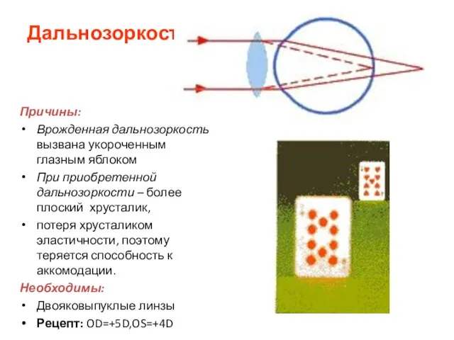 Дальнозоркость Причины: Врожденная дальнозоркость вызвана укороченным глазным яблоком При приобретенной дальнозоркости –