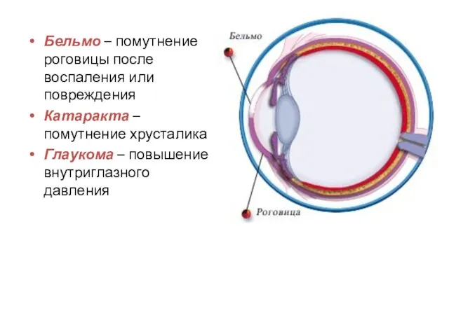 Бельмо – помутнение роговицы после воспаления или повреждения Катаракта – помутнение хрусталика