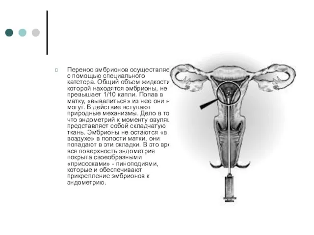 Перенос эмбрионов осуществляется с помощью специального катетера. Общий объем жидкости, в которой