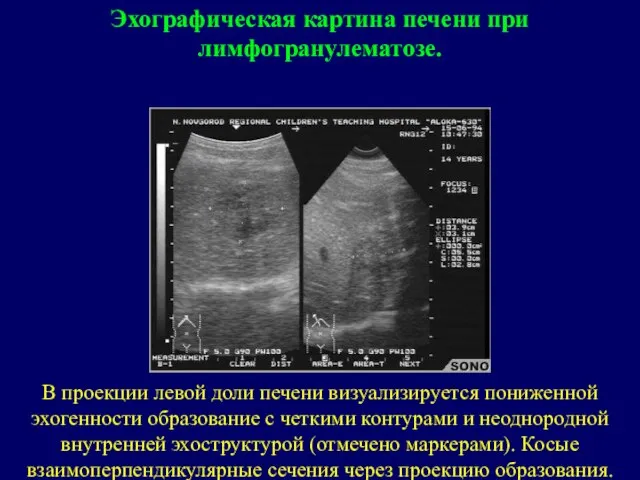 В проекции левой доли печени визуализируется пониженной эхогенности образование с четкими контурами