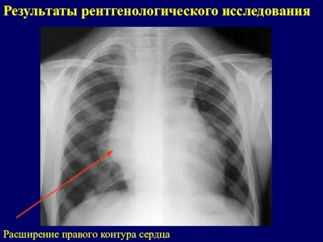 Результаты рентгенологического исследования Расширение правого контура сердца