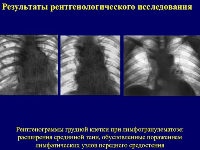 Результаты рентгенологического исследования Рентгенограммы грудной клетки при лимфогранулематозе: расширения срединной тени, обусловленные
