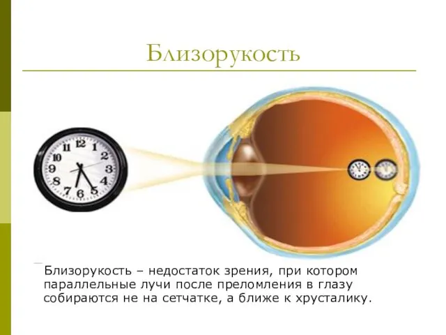 Близорукость Близорукость – недостаток зрения, при котором параллельные лучи после преломления в