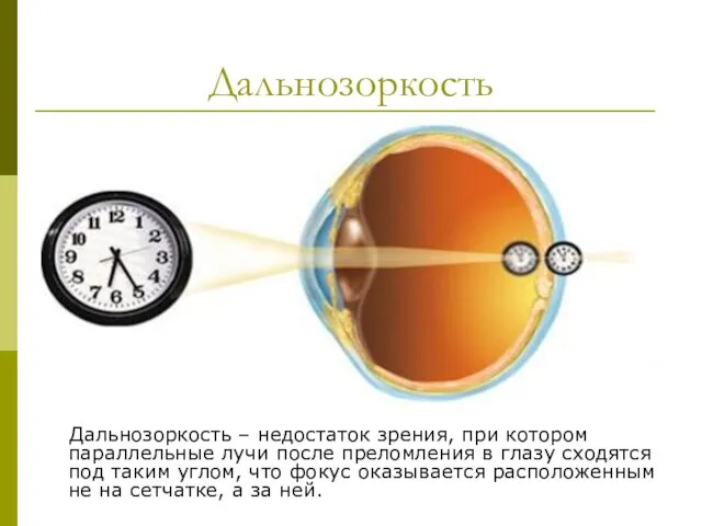 Дальнозоркость Дальнозоркость – недостаток зрения, при котором параллельные лучи после преломления в