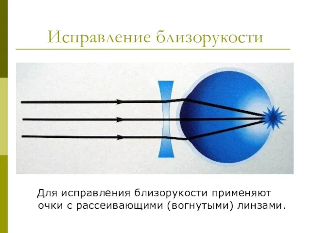 Исправление близорукости Для исправления близорукости применяют очки с рассеивающими (вогнутыми) линзами.