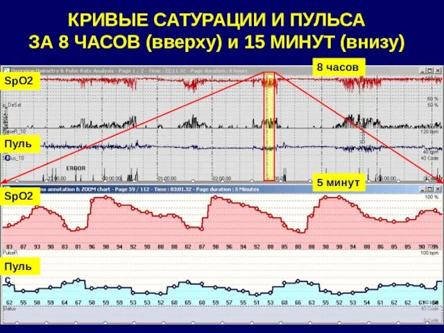 КРИВЫЕ САТУРАЦИИ И ПУЛЬСА ЗА 8 ЧАСОВ (вверху) и 15 МИНУТ (внизу)