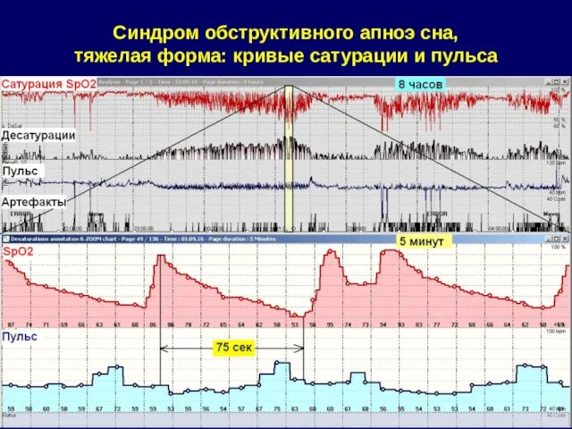 Синдром обструктивного апноэ сна, тяжелая форма: кривые сатурации и пульса