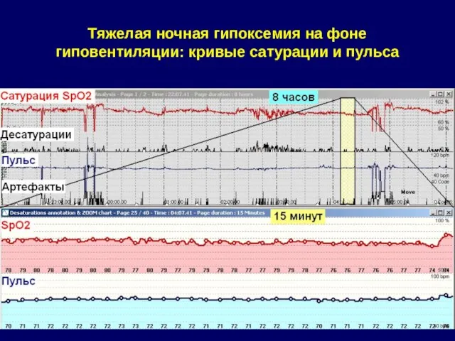 Тяжелая ночная гипоксемия на фоне гиповентиляции: кривые сатурации и пульса