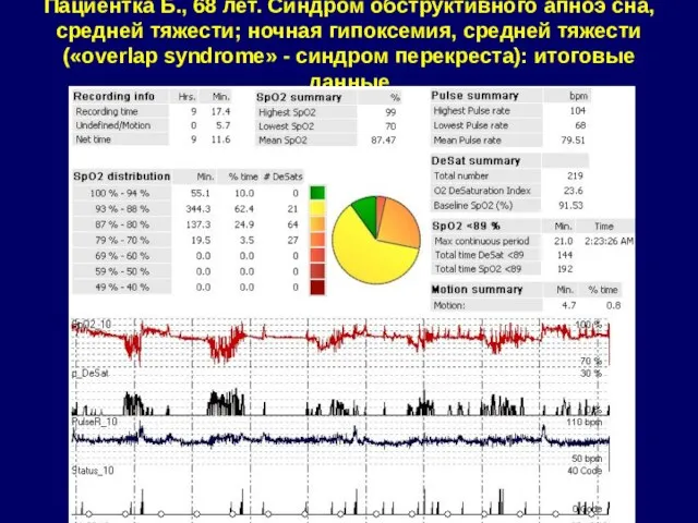 Пациентка Б., 68 лет. Синдром обструктивного апноэ сна, средней тяжести; ночная гипоксемия,