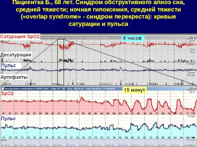 Пациентка Б., 68 лет. Синдром обструктивного апноэ сна, средней тяжести; ночная гипоксемия,