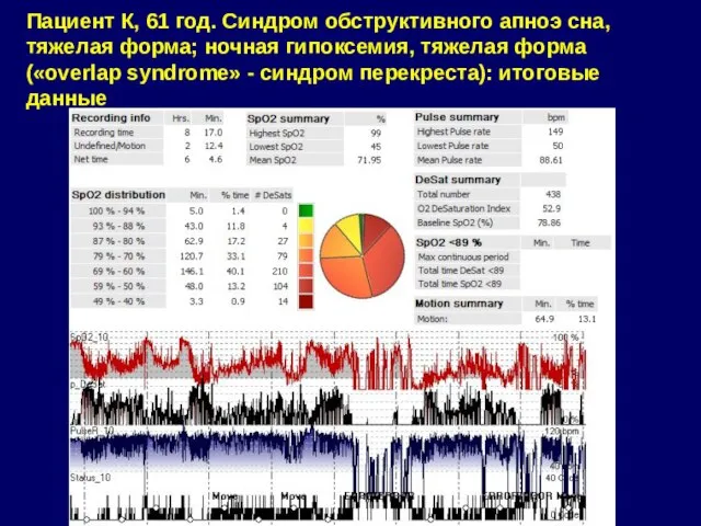 Пациент К, 61 год. Синдром обструктивного апноэ сна, тяжелая форма; ночная гипоксемия,