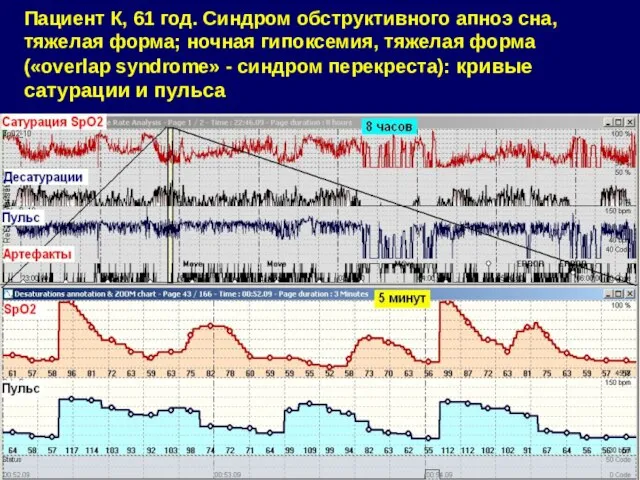 Пациент К, 61 год. Синдром обструктивного апноэ сна, тяжелая форма; ночная гипоксемия,