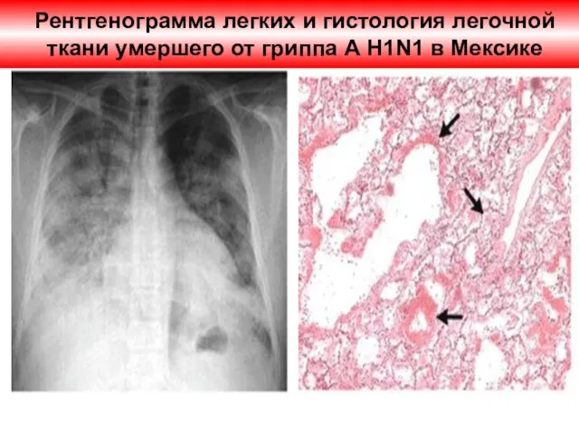 Рентгенограмма легких и гистология легочной ткани умершего от гриппа А H1N1 в Мексике