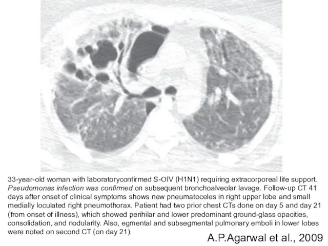 33-year-old woman with laboratoryconfirmed S-OIV (H1N1) requiring extracorporeal life support. Pseudomonas infection