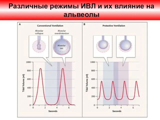 Различные режимы ИВЛ и их влияние на альвеолы