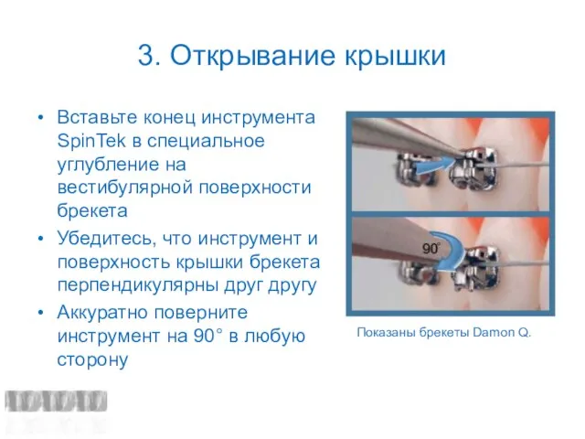 3. Открывание крышки Вставьте конец инструмента SpinTek в специальное углубление на вестибулярной