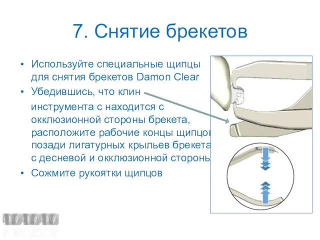 7. Снятие брекетов Используйте специальные щипцы для снятия брекетов Damon Clear Убедившись,