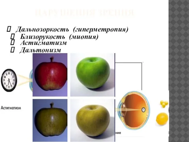 НАРУШЕНИЯ ЗРЕНИЯ Дальнозоркость (гиперметропия) Близорукость (миопия) Астигматизм Дальтонизм