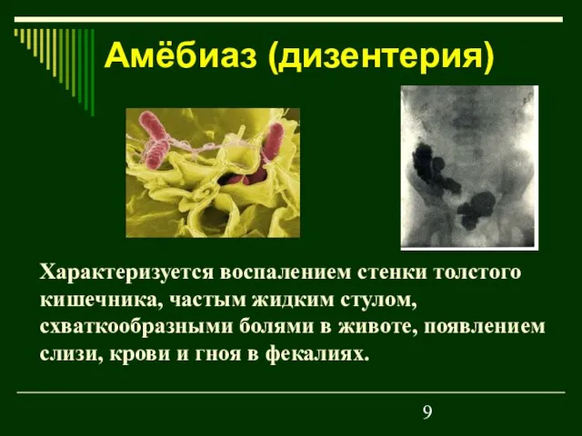 Характеризуется воспалением стенки толстого кишечника, частым жидким стулом, схваткообразными болями в животе,