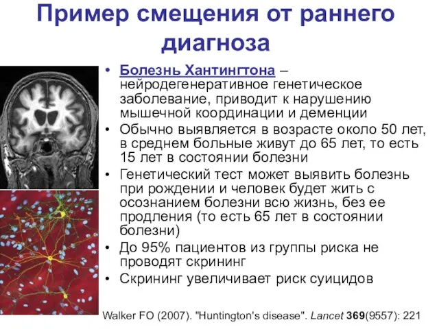 Пример смещения от раннего диагноза Болезнь Хантингтона – нейродегенеративное генетическое заболевание, приводит