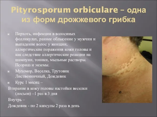 Pityrosporum orbiculare – одна из форм дрожжевого грибка Перхоть, инфекции в волосяных