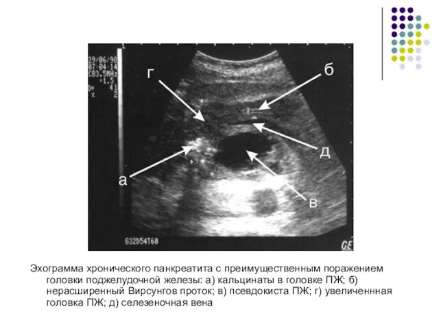 Эхограмма хронического панкреатита с преимущественным поражением головки поджелудочной железы: а) кальцинаты в