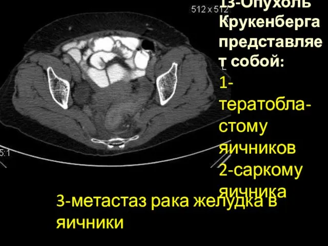 13-Опухоль Крукенберга представляет собой: 1-тератобла-стому яичников 2-саркому яичника 3-метастаз рака желудка в яичники