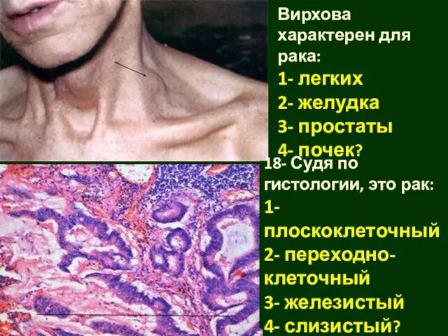 17- Метастаз Вирхова характерен для рака: 1- легких 2- желудка 3- простаты