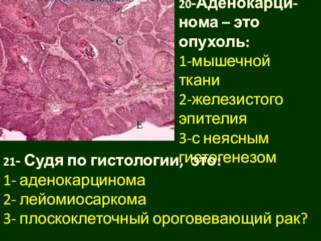 20-Аденокарци-нома – это опухоль: 1-мышечной ткани 2-железистого эпителия 3-с неясным гистогенезом 21-